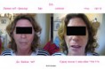 /album/photogallery/mblbeforeafterlips-jpg/